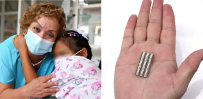 Alerta en Perú por ingesta de imanes en niños: niña de 9 años sobrevive tras tragar 20 piezas