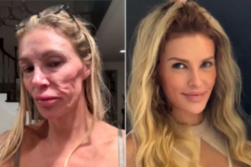 Brandi Glanville revela que implantes mamarios rotos causaron su desfiguración facial