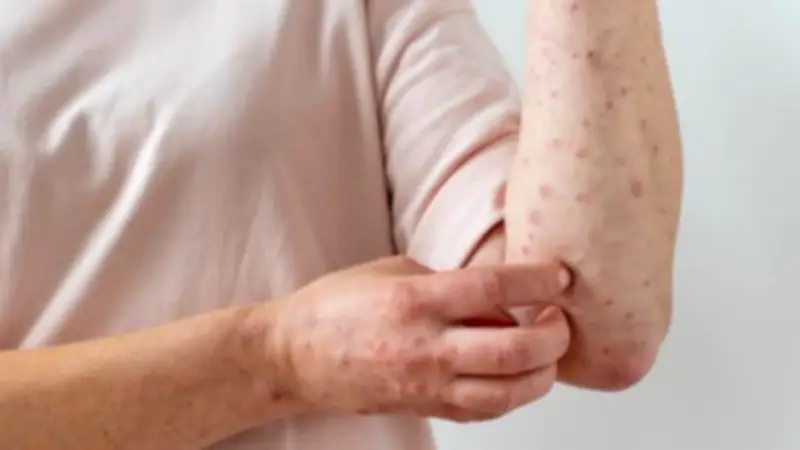 Colombia activa alerta sanitaria por sarampión ante la Copa Mundial FIFA 2026