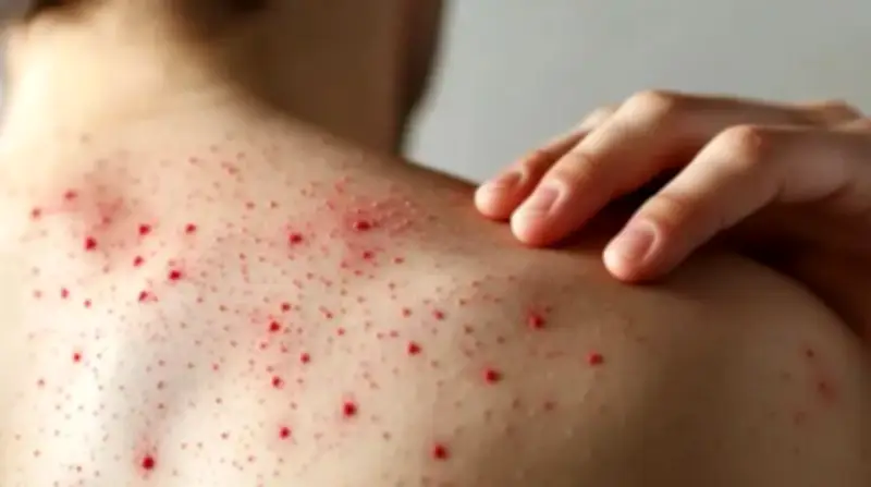 Colombia confirma tres casos importados de sarampión tras una década sin contagios