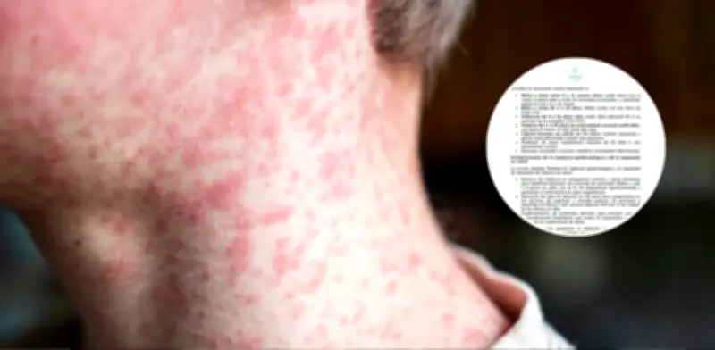 Colombia confirma tres casos importados de sarampión y refuerza vacunación ante Mundial 2026