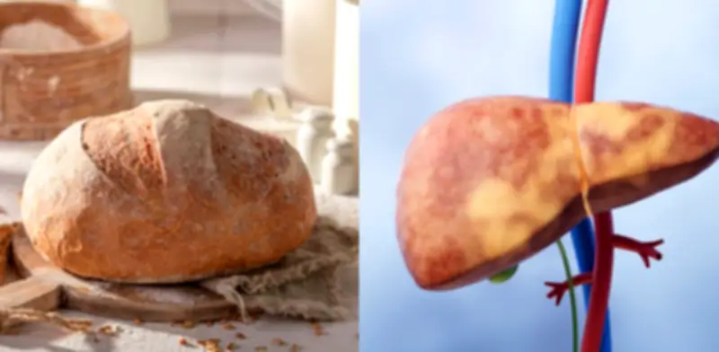 Hígado graso: límites diarios de pan blanco para evitar complicaciones hepáticas