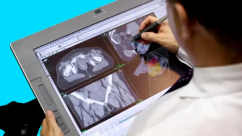 INC marca hito en Colombia con innovador procedimiento contra cáncer de próstata