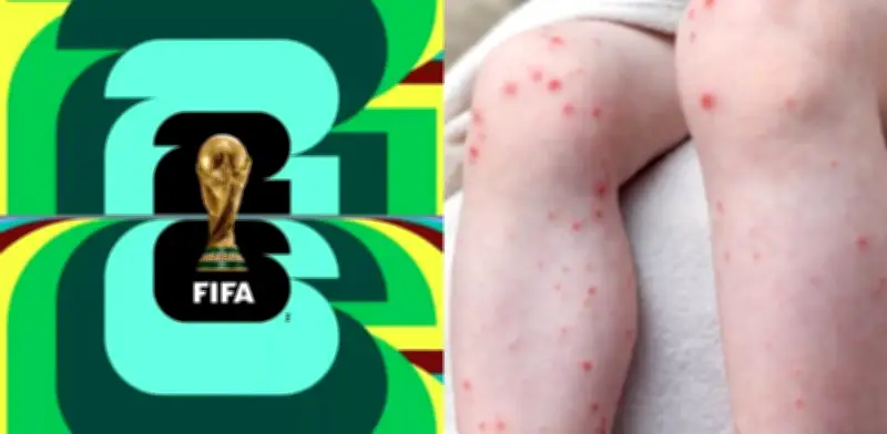 Ministerio de Salud alerta sobre riesgo de sarampión en Mundial FIFA 2026 y emite recomendaciones