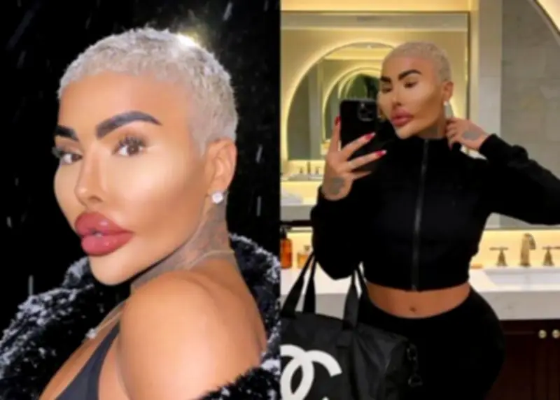 Muerte de influencer británico Jordan James Parke reabre debate sobre riesgos de cirugías estéticas extremas