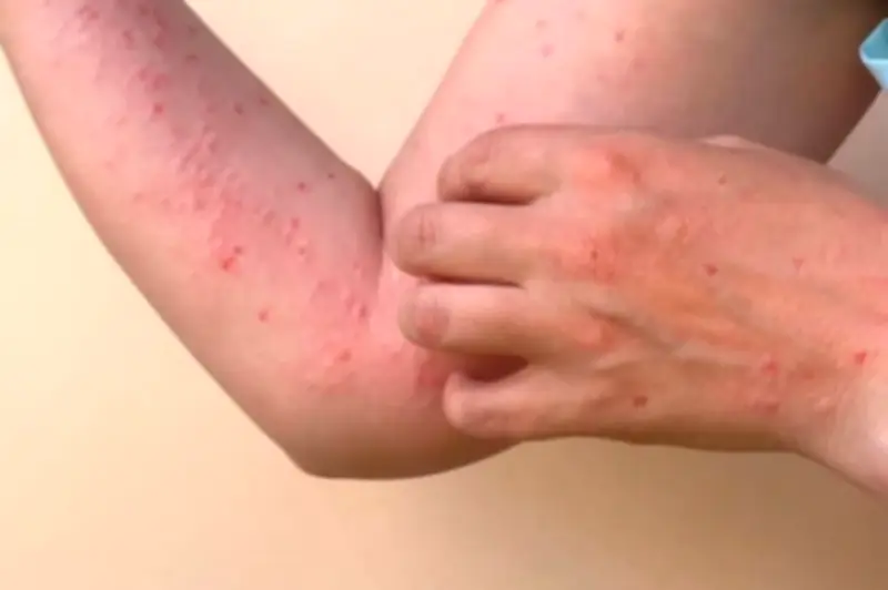 Santander reporta nuevos casos de viruela del mono con contagios confirmados en Bucaramanga y Piedecuesta