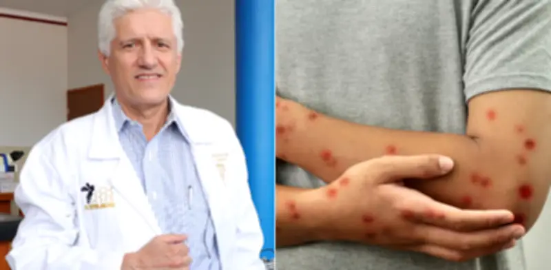 Sarampión en adultos: síntomas más graves y recomendaciones de vacunación