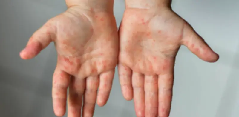 Viruela del mono se expande en Santander: casos confirmados en Piedecuesta y Barrancabermeja