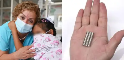 Alerta en Perú por ingesta de imanes en niños: niña de 9 años sobrevive tras tragar 20 piezas