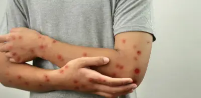 Bogotá activa cerco epidemiológico tras confirmar caso importado de sarampión