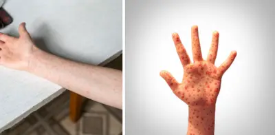 Bogotá confirma caso importado de sarampión en adulto procedente de México