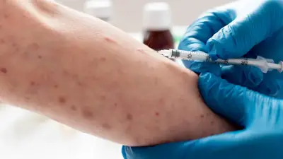 Colombia activa alerta: estas son las personas que deben vacunarse contra el sarampión