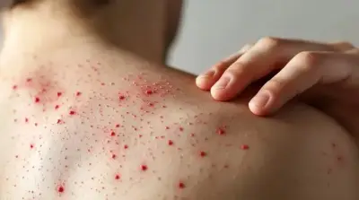 Colombia confirma tres casos importados de sarampión tras una década sin contagios