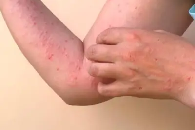 Santander reporta nuevos casos de viruela del mono con contagios confirmados en Bucaramanga y Piedecuesta