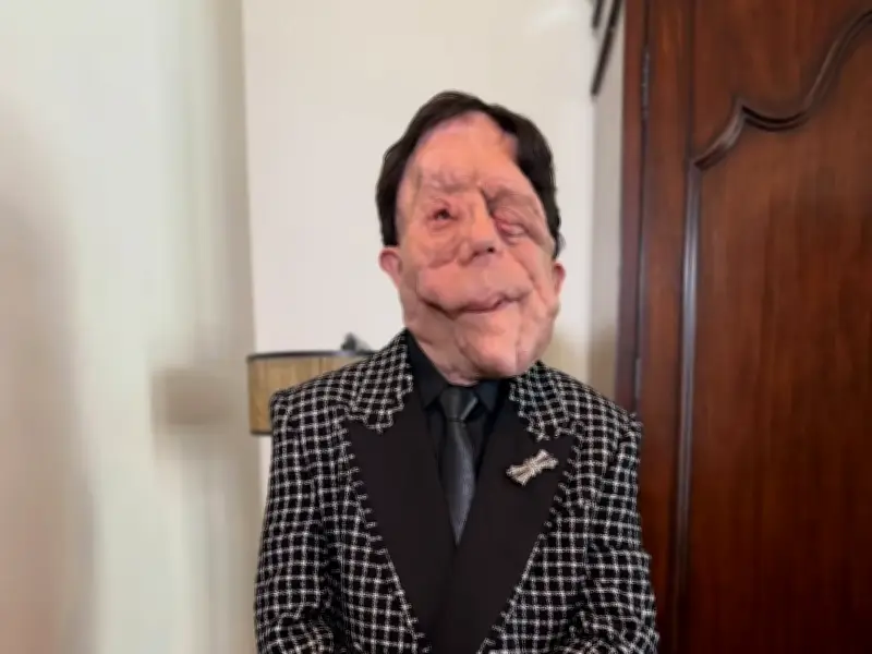 Adam Pearson: El actor con fibromatosis tipo 1 que brilló en los Óscar 2026