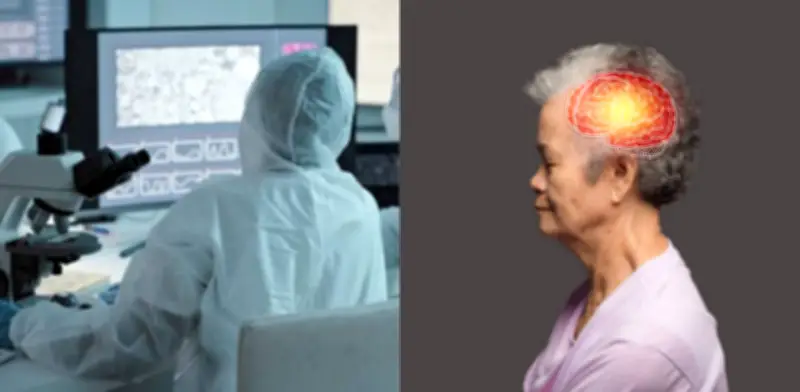 Alzhéimer progresa hasta 20 veces más rápido en mujeres por acumulación de proteínas, revela estudio