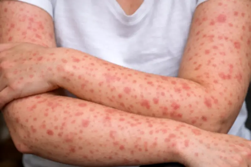 Barrancabermeja activa protocolos preventivos tras primer caso de sarampión en Santander