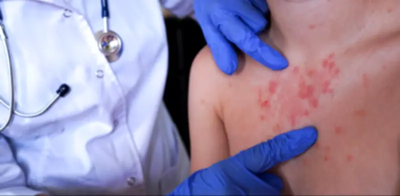 Bogotá concentra tres de los cuatro casos importados de sarampión confirmados en Colombia