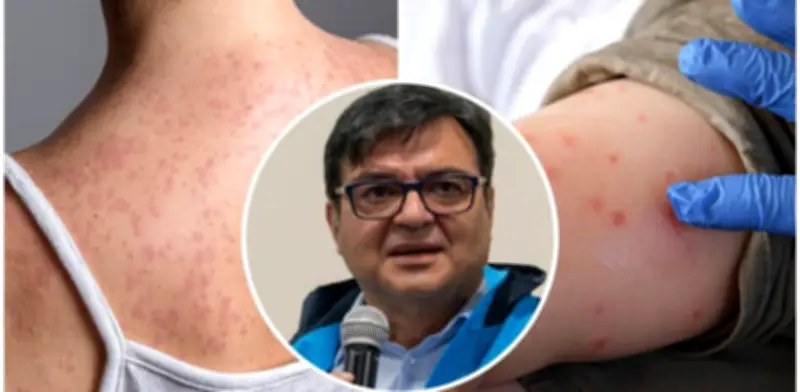 Bogotá enfrenta escasez crítica de vacunas contra el sarampión con solo 5.000 dosis disponibles