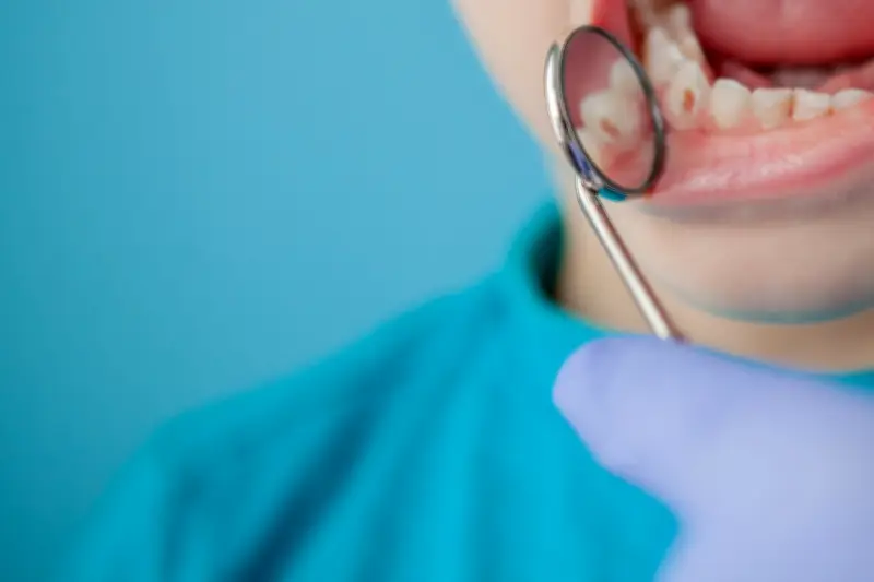 Caries dentales: más que un problema común, un riesgo para la salud oral integral