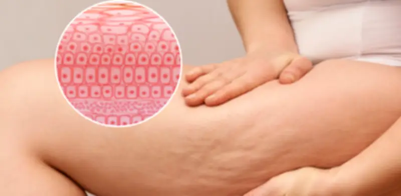 Celulitis: causas y tratamientos médicos que pueden mejorar su apariencia temporalmente