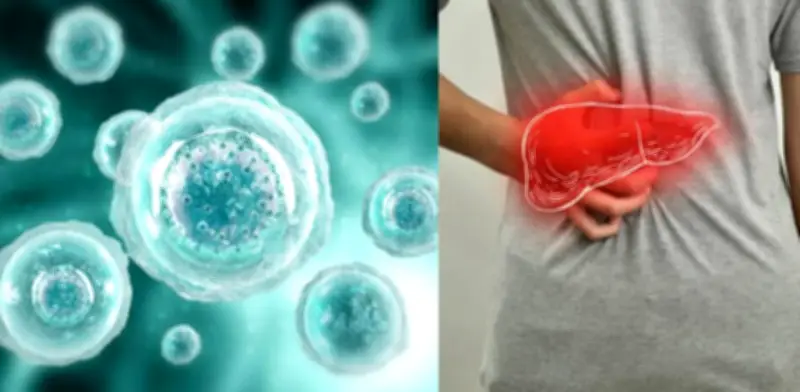 Células zombis de la Clínica Mayo desencadenan inflamación en hígado graso