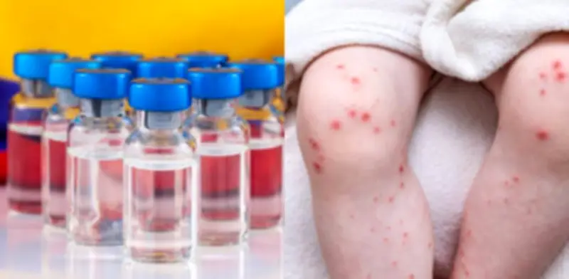 Cómo verificar si tiene la vacuna contra el sarampión en Colombia: recomendaciones del Ministerio de Salud