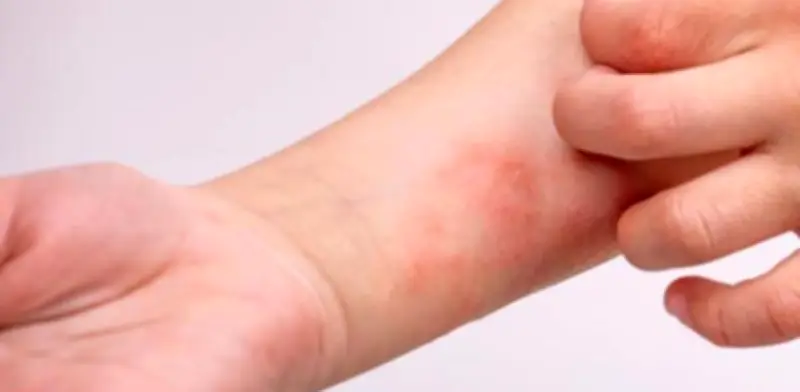 Colombia activa protocolos por sarampión ante inminente Mundial de Fútbol 2026