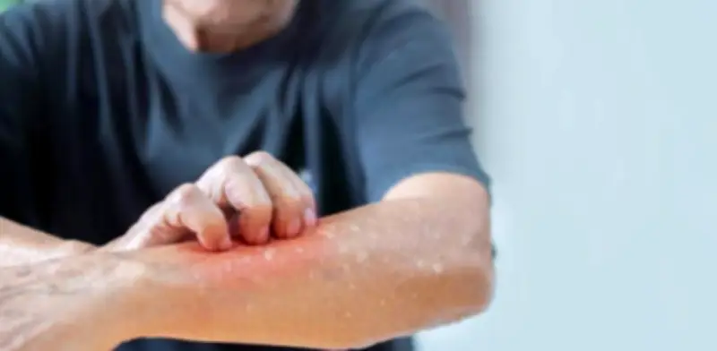 Colombia confirma cuarto caso importado de sarampión en 2026 mientras refuerza vigilancia nacional