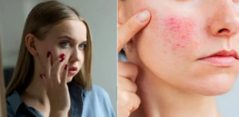 Dermatólogos alertan sobre el infradiagnóstico de la rosácea y sus riesgos sin tratamiento