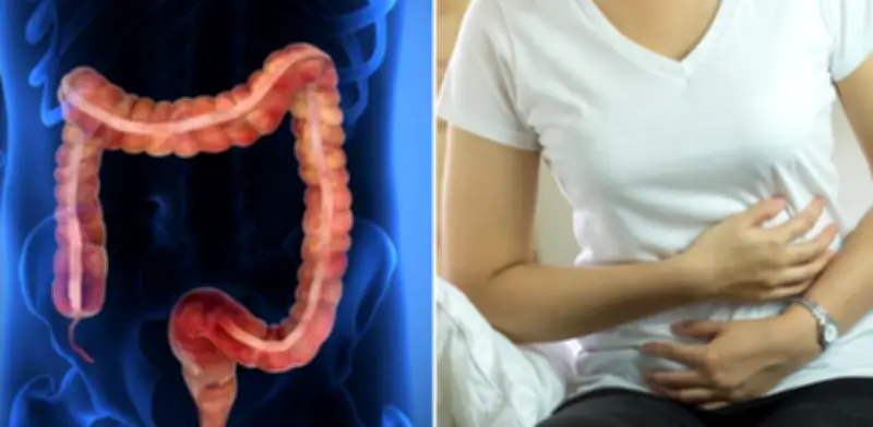 Estudio de Harvard revela que inflamación intestinal deja 'memoria' epigenética que eleva riesgo de cáncer colorrectal