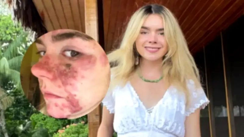 Exreina de belleza revela su batalla contra el acné severo y crea comunidad de apoyo