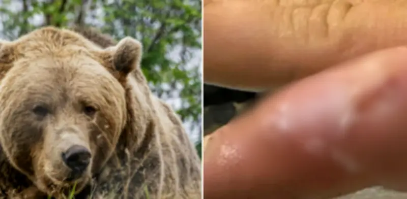Hombre contrae rara infección 'dedo de foca' tras contacto con oso pardo en Alaska