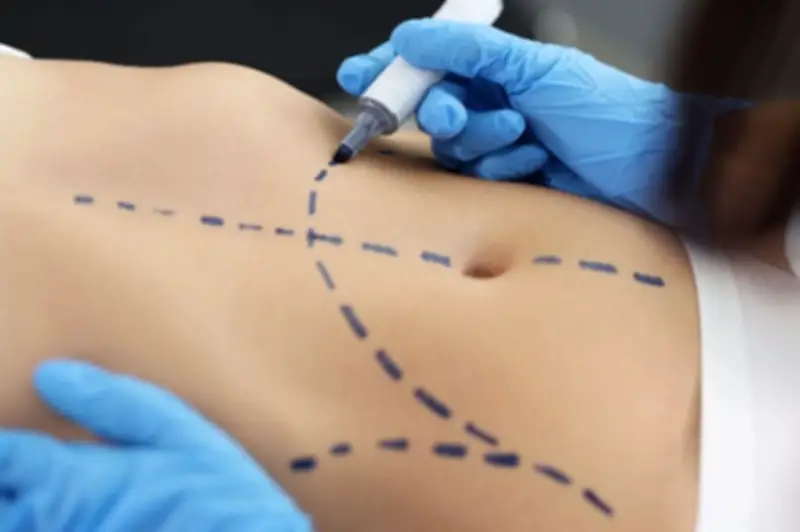 Justicia colombiana ratifica que cirugías plásticas son obligación de medios, no de resultados