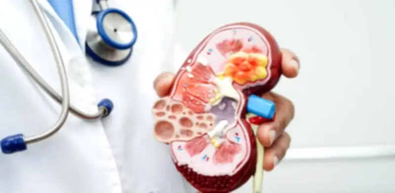 Los 9 alimentos que elevan el riesgo de cálculos renales y alternativas saludables