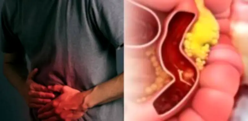 Santander ocupa el tercer lugar en cáncer colorrectal en Colombia: claves para prevenir la enfermedad