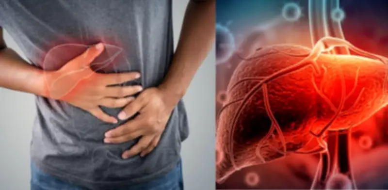 Síntomas tempranos de la cirrosis hepática: señales que no deben ignorarse