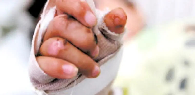 Tragedia en fiesta infantil de La Unión: bebé de 21 meses en estado crítico tras explosión de globo