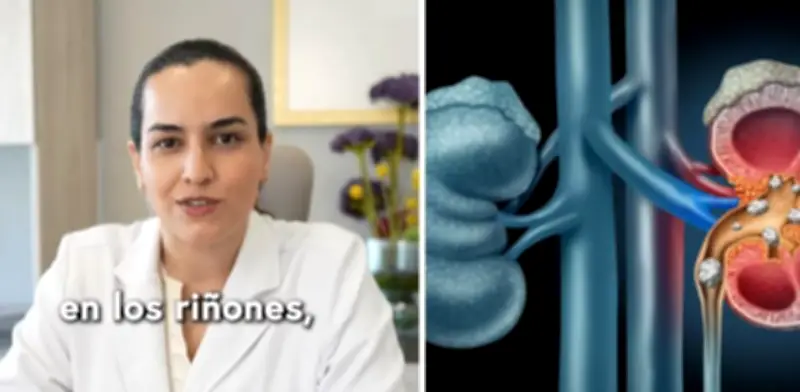 Uróloga desmiente mito: eliminar lácteos no previene cálculos renales