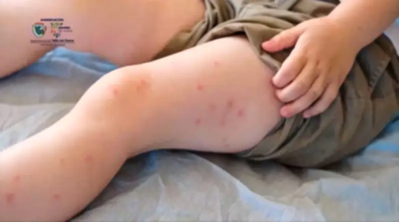 Valle del Cauca activa plan de contingencia ante alerta nacional por casos de sarampión