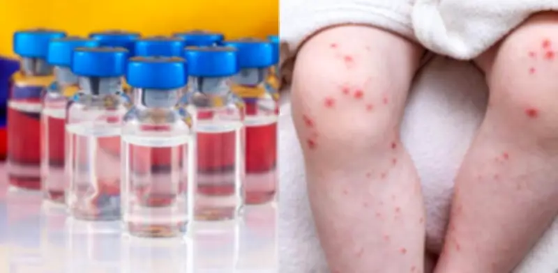 Valle del Cauca enfrenta desabastecimiento crítico de vacunas contra el sarampión