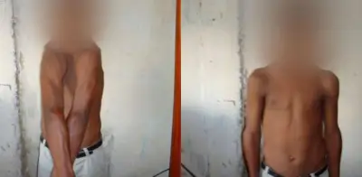 Displasia Cleidocraneal ingresa oficialmente a lista de enfermedades huérfanas en Colombia