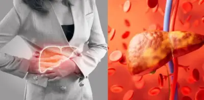 Hígado graso: síntomas iniciales y alimentos prohibidos según expertos médicos