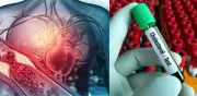 Actualizan guías médicas del colesterol con nuevos límites para prevenir infartos y ACV