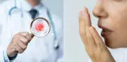 El mal aliento persistente puede ser señal temprana de varios tipos de cáncer