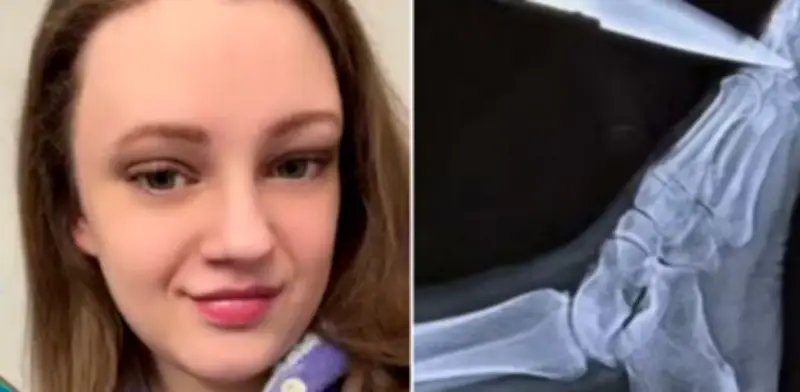 Accidente doméstico revela quiste ovárico mortal en mujer de 31 años