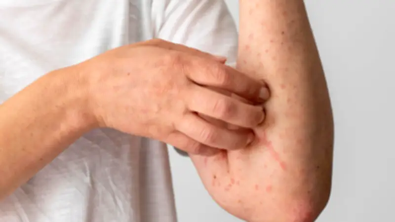 Alerta por aumento de casos de varicela en Colombia: 5.709 reportes en 2026