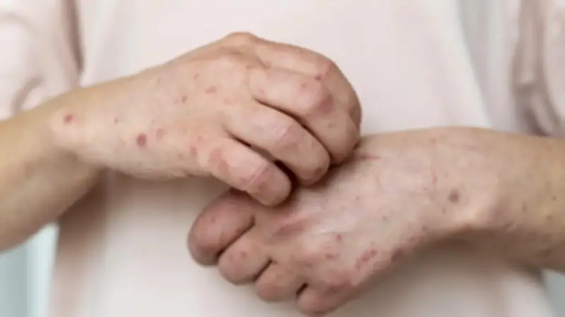 Alerta por aumento de casos de varicela en Colombia: síntomas que no debe ignorar