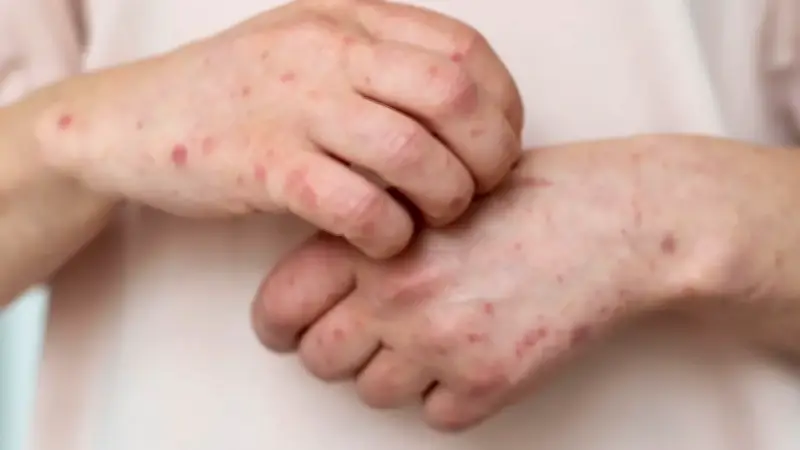 Alerta por sarampión en Colombia: casos importados y riesgo de propagación