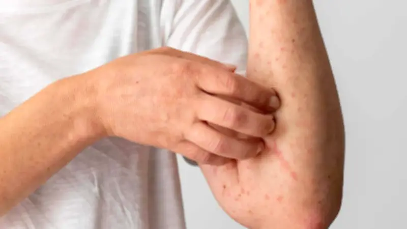 Colombia confirma primer caso de viruela símica clado Ib en Antioquia